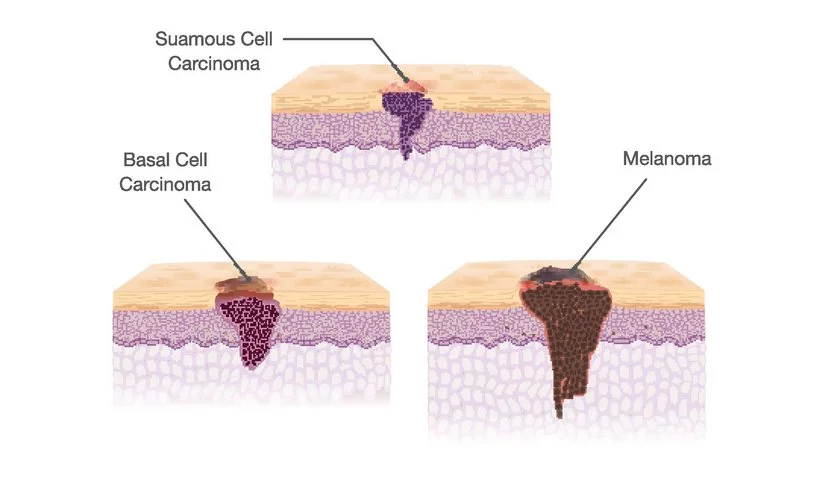 image showing different types of skin cancer