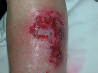 squamous cell carcinoma located on the arm of a patient