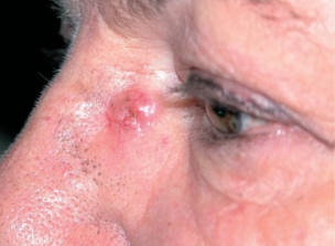 A basal cell carcinoma on the nose next to the eye of the patient