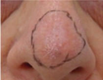 A basal cell carcinoma located at the tip of the nose