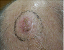 a basal cell carcinoma located on the scalp of the patient