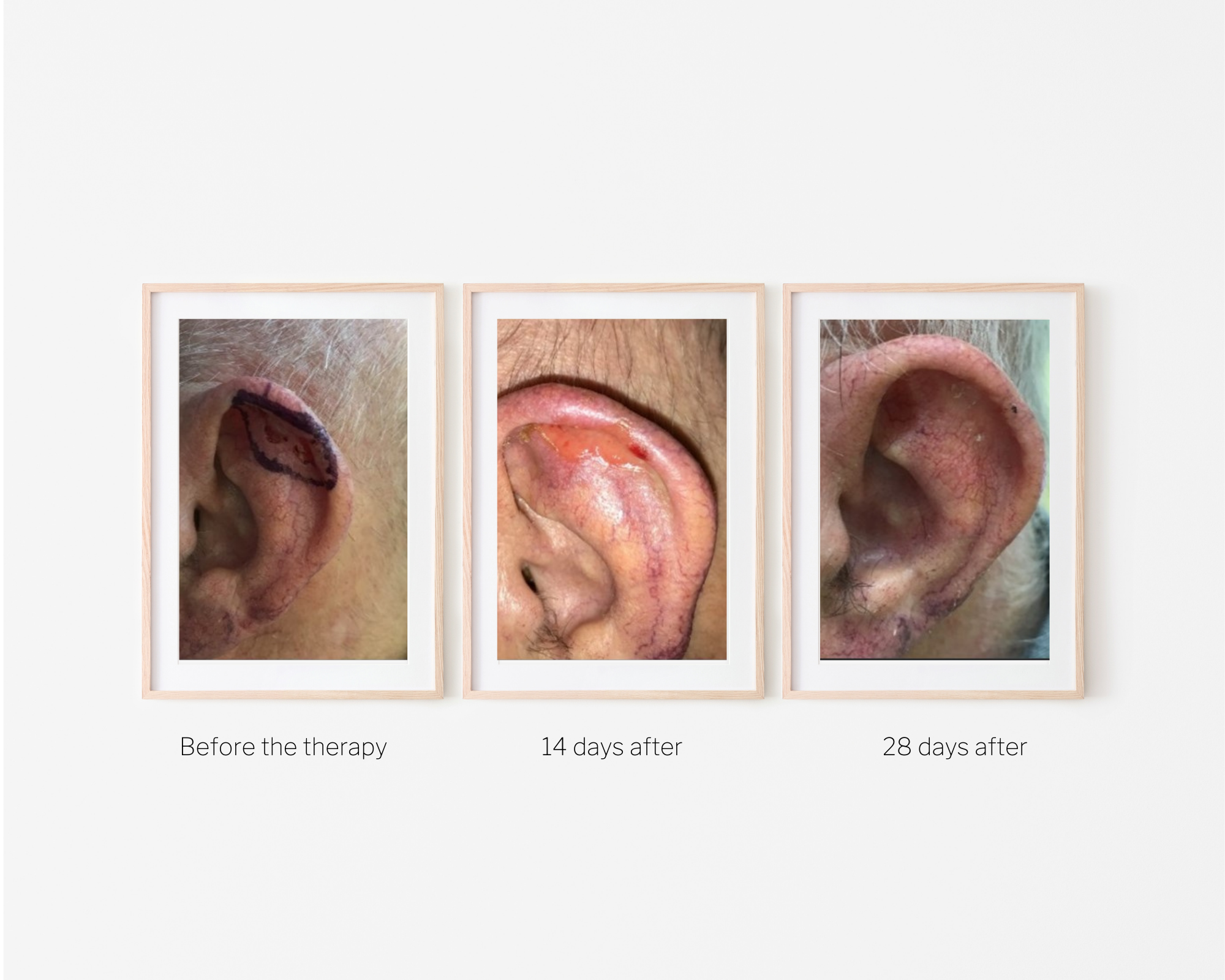 Image collage of a lesion on an ear before the treatment, two weeks after the treatment and one month after the treatment