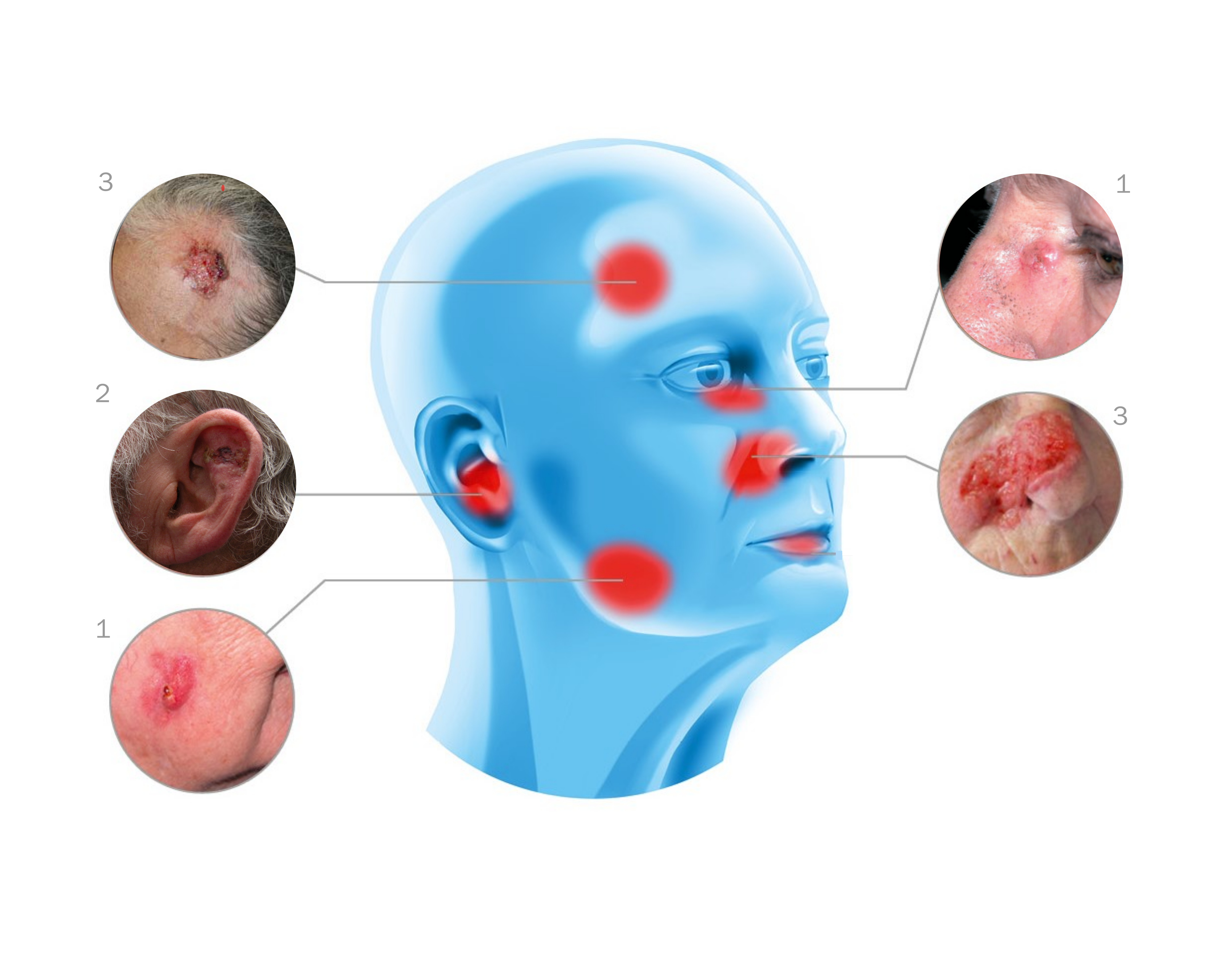 Examples of lesions on the human face