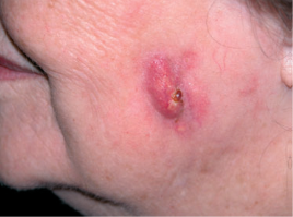 a squamous cell carcinoma located on the cheek of the patient