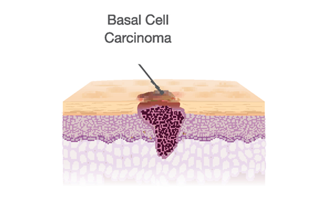 a traversal cut of a basal cell carcinoma