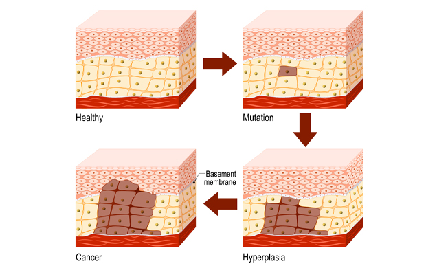 the development of skin cancer in four stages
