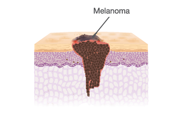 a traversal cut of a melanoma