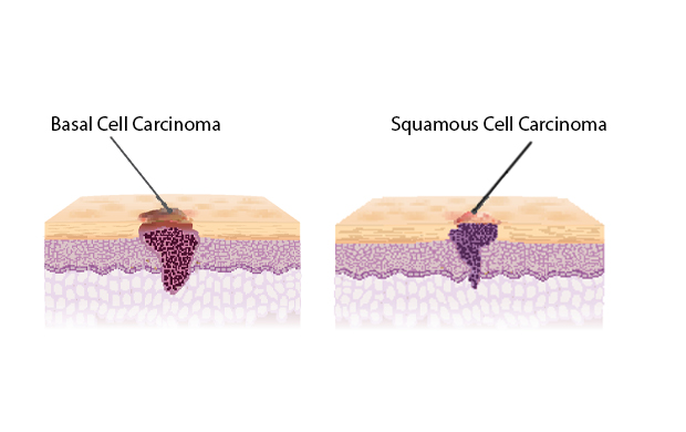 traversal cuts of basal and squamous cell carcinomas