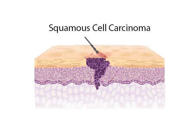 a traversal cut of a squamous cell carcinoma