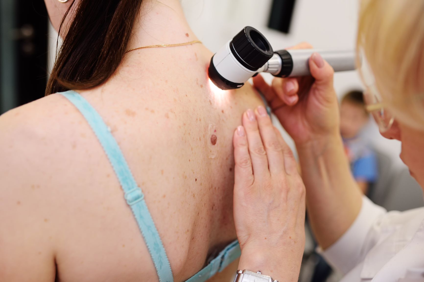 A patients back being examined with a dermascope