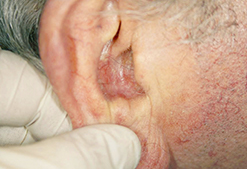 ear after treatment