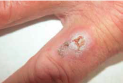 finger after treatment