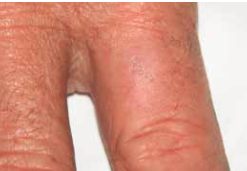 finger before treatment
