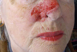 womans nose before treatment
