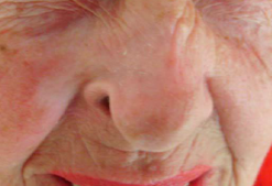 womans nose after treatment