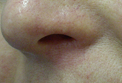 nose after treatment