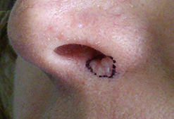 nose before treatment